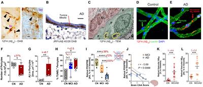 Retinal Vasculopathy in Alzheimer’s Disease